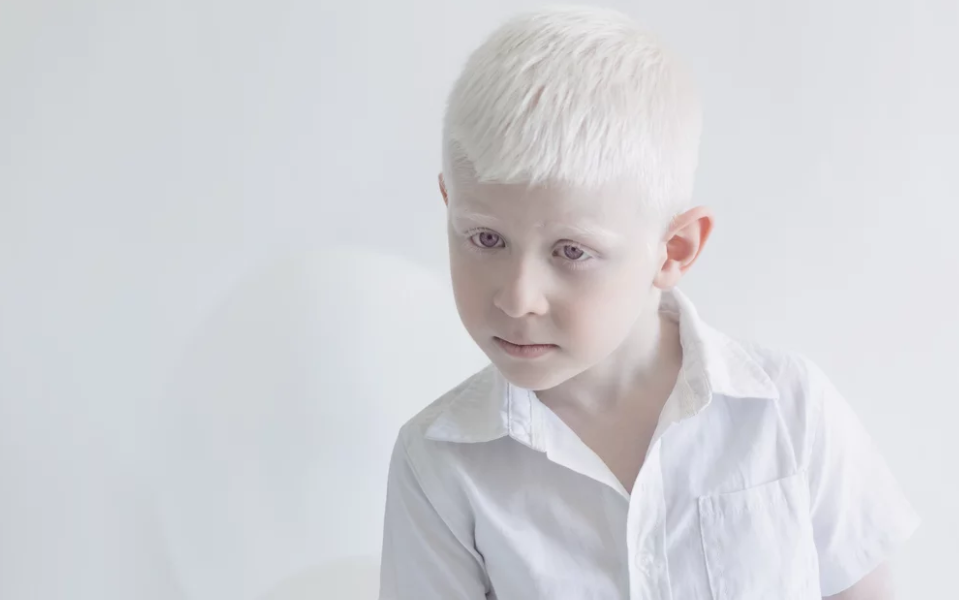 albinism-definition-archives-vdio-magazine-2024